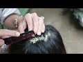 removed hundred of lice from head and dry scalp huge dandruff of flakes removal with comb 1765