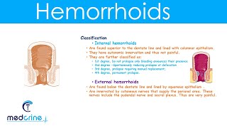 Hemorrhoids : causes,types,clinical features,diagnosis and treatment