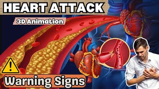 Recognizing a Heart Attack | 3D Animation | Heart Attack Symptoms In Hindi-Urdu