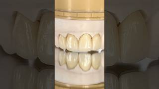 Upper Monet Pure Zirconia Anterior Crowns #lsk121shorts #dental #teeth