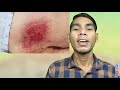 🚷tuti 🦴 haddi ka nahi judna non union fracture treatment in hindi how to heal nonunion fracture