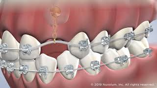 Assisted Eruption of Impacted Teeth at Warren Orthodontics, Springville, UT