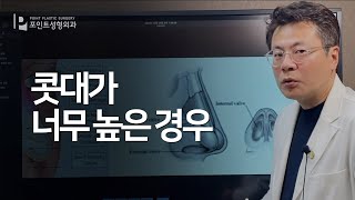 콧대가 너무 높은 경우 재수술