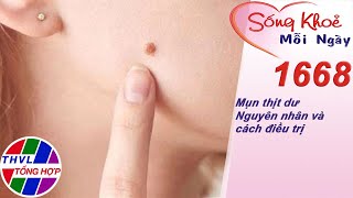 Mụn thịt dư - Nguyên nhân và cách điều trị | Sống khỏe mỗi ngày - Kỳ 1668