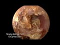 ear wax removal