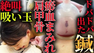 【閲覧注意　瘀血　鍼灸】瘀血ドバドバ　肩甲骨はがし必須　恐ろしく硬すぎる首肩肩甲骨 吸い玉と刺絡、鍼灸で治す　自宅でできる方法も伝授 【横浜元町　銀座日本橋　鍼灸院】