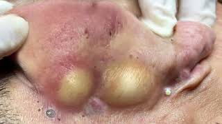 08 acne blackheads whiteheads removal,cystic blackhead whitehead removal,big cystic acneextraction