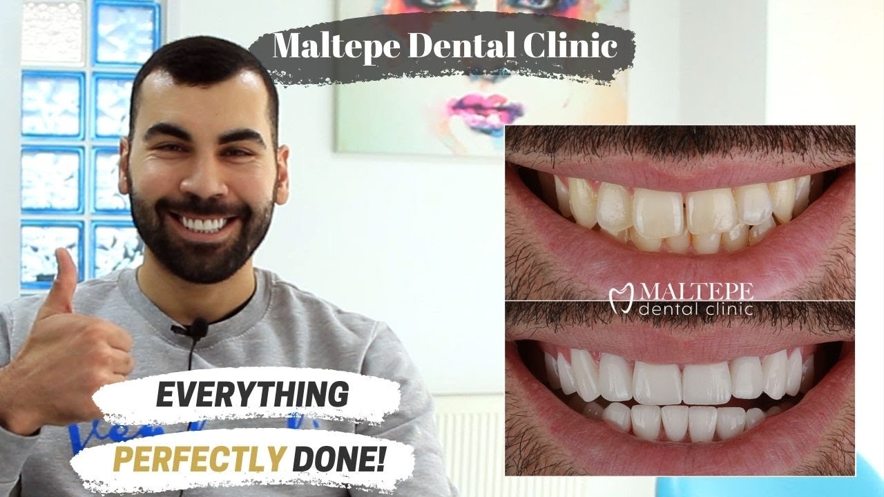 Dental Veneers Treatment In Turkey | Maltepe Dental Clinic, Istanbul ...