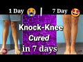 Knock knee problem solution with EXERCISES in 7 days