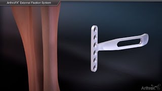 ArthroFX™ External Fixation System