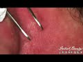 耳朵後面粗黑頭 blackheads behind the ear taiwan tainan台南清粉刺最乾淨