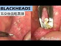 耳朵後面粗黑頭(blackheads behind the ear) - Taiwan Tainan台南清粉刺最乾淨