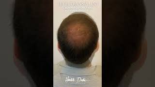 From Thinning to Thick: A Hair Transplant Transformation