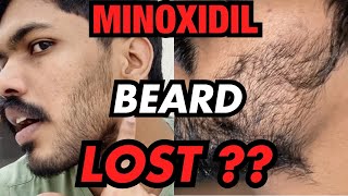 GUYS താടി കൊഴിഞ്ഞു പോവാൻ തുടങ്ങി |Losing My Beard\u0026Hair