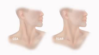 TCAR: UNCLOGGING CAROTID ARTERIES