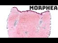 Morphea under the microscope (localized scleroderma) skin disease histology pathology dermatology