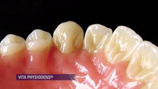 Selecting the Right Denture to Replicate Natural Morphology