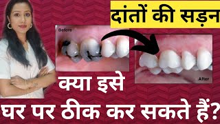 Danto Ki Sadan Ka Ilaj |दांतों की सड़न को घर पर ठीक कर सकते हैं?  |Can We Remove Teeth Decay At Home