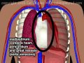 hemothorax due to aortic rupture in aortic dissection by cal shipley m.d.