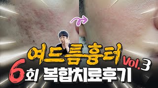 여드름흉터 6회 복합치료 후기 3편. 네이버 피부인 카페