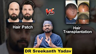 Hair Patch Vs Hair Transplant | జుట్టు విగ్ లేదా జుట్టు మార్పిడి | Which Is Better And Why?