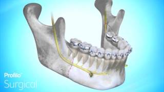 BSSO | Lower Jaw Advancement Surgery