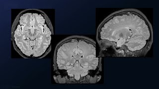 Supratentorial-Infraoccipital Approach for Resection of a Mesial Temporal Cavernous Malformation