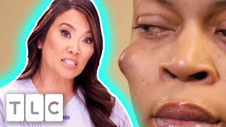 Patient 'Could Be A Model' After Removing Eyeball-Sized Cyst On Her Face | Dr. Pimple Popper Pop Ups