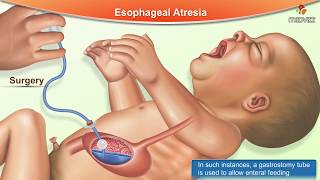 Esophageal Atresia : Etiology, Types, Pathophysiology , Clinical Features , Diagnosis and Treatment
