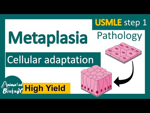 Metaplasia Cellular adaptation examples of metaplasia