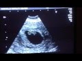 7 Week and 1 Day Ultrasound