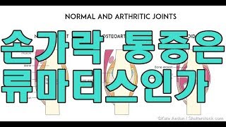 손가락이 아프면 류마티스관절염(Rheumatoid Arthritis)?