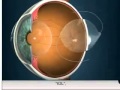 Multifocal Intraocular Lens