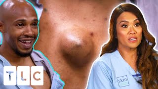 Dr Sandra Lee Removes Larry The Lump From Man’s Chest | Dr Pimple Popper | CENSORED