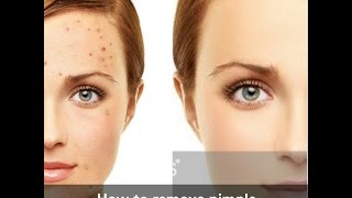 ব্রণ,ব্রনের কালো দাগ দূর করুন মাত্র ৭ দিনে।। How to remove Pimples,Black spots ।। 100% Works)