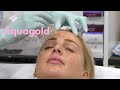 Aqua Gold Facial Before and After with Chloe ✨ Dr. Nina Bal Facial Sculpting