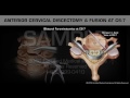 Anterior Cervical Discectomy & Fusion at C6-7