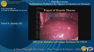 MIS Liver Ablation and Image Guidance for CRLM