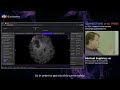 connectome of the week cotw episode 06 medial frontal partially butterflying glioblastoma