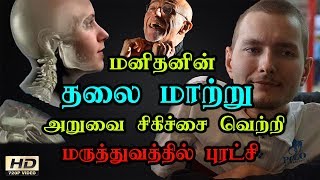 World's first human head transplant |  உலகின் முதல் தலை மாற்று அறுவை சிகிச்சை | Tamil 360