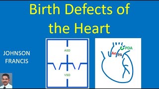Birth Defects of the Heart