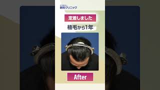 【植毛1年後】生え際・頭頂部に2000株移植された体験者様へお話を伺いました。【 新宿・名古屋・大阪・福岡 】#shorts