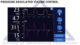 Modes of mechanical ventilation: Pressure Regulated Volume Control  (PRVC)