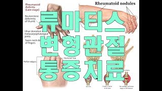 류마티스관절염(Rheumatoid Arthritis) 손가락 변형과 통증