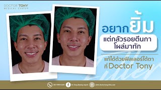 อยากยิ้ม แต่รอยตีนกาโผล่มาทัก แก้ได้ด้วย ฟิลเลอร์ ที่ Doctor Tony