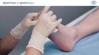 AQUACEL® Foam and AQUACEL® Ribbon Application - Diabetic Foot Ulcer