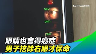 眼睛也會得癌症？他眼睛紅腫看醫生被當「結膜炎」　最後挖除右眼才保命｜祝你健康