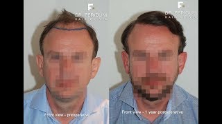 Hair transplant FUE 3359 grafts - english