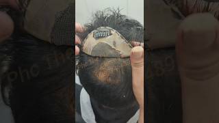 Clip Hair Patch Delhi India #reels #nonsurgical #nonstop #video #viral #scalp #bald #treatment