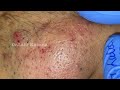 best of blackheads removal by dr lalit kasana repost